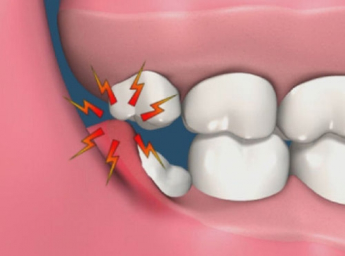 Pericoronarite Giuseppe Ventura Da Oltre Anni Dentista A Sassuolo